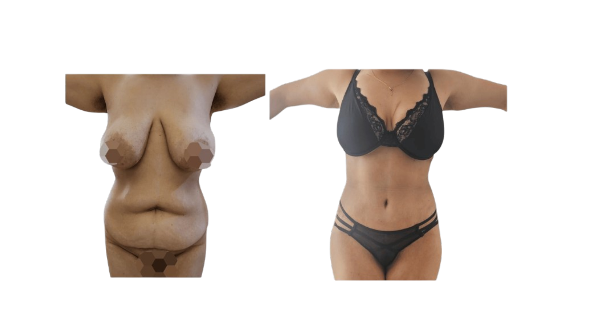 Abdominoplastie - avant / après