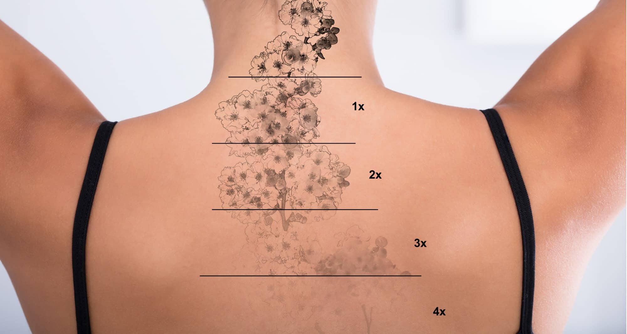 Détatouage laser