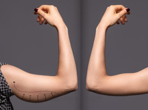 Lifting des bras