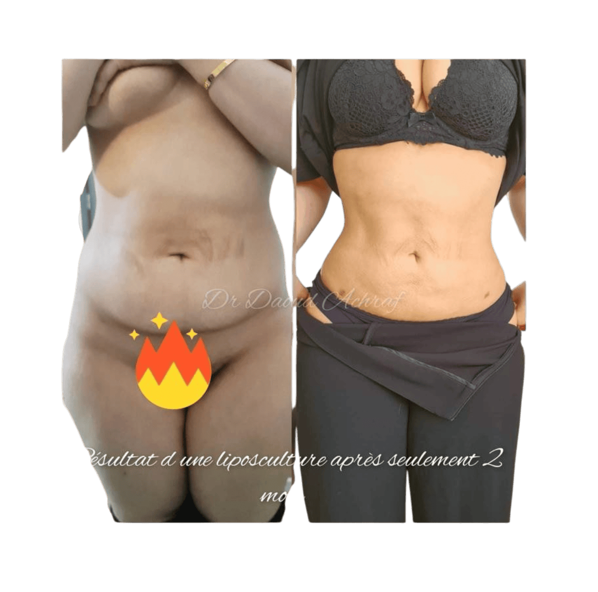 Abdominoplastie - avant / après