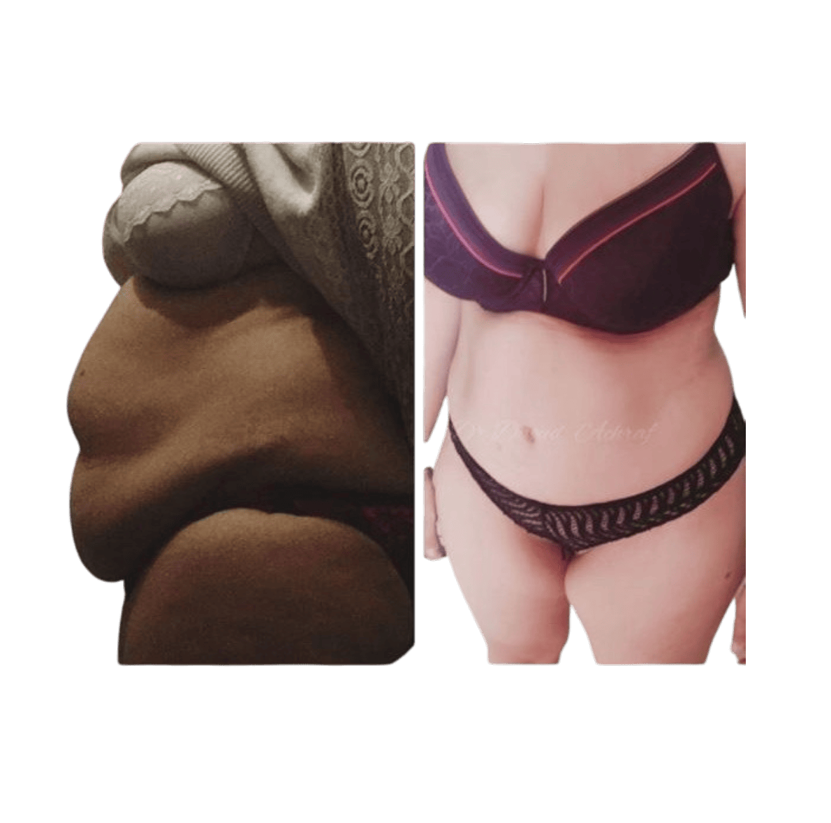 Abdominoplastie - avant / après