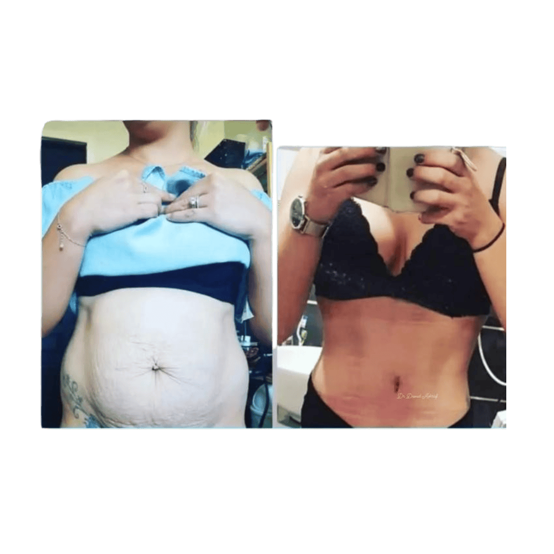 Abdominoplastie - avant / après