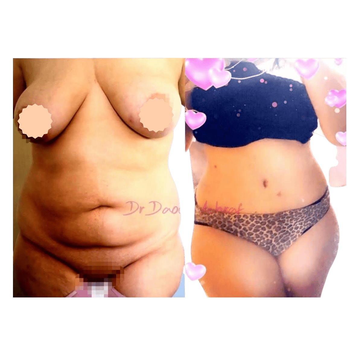 Abdominoplastie - avant / après