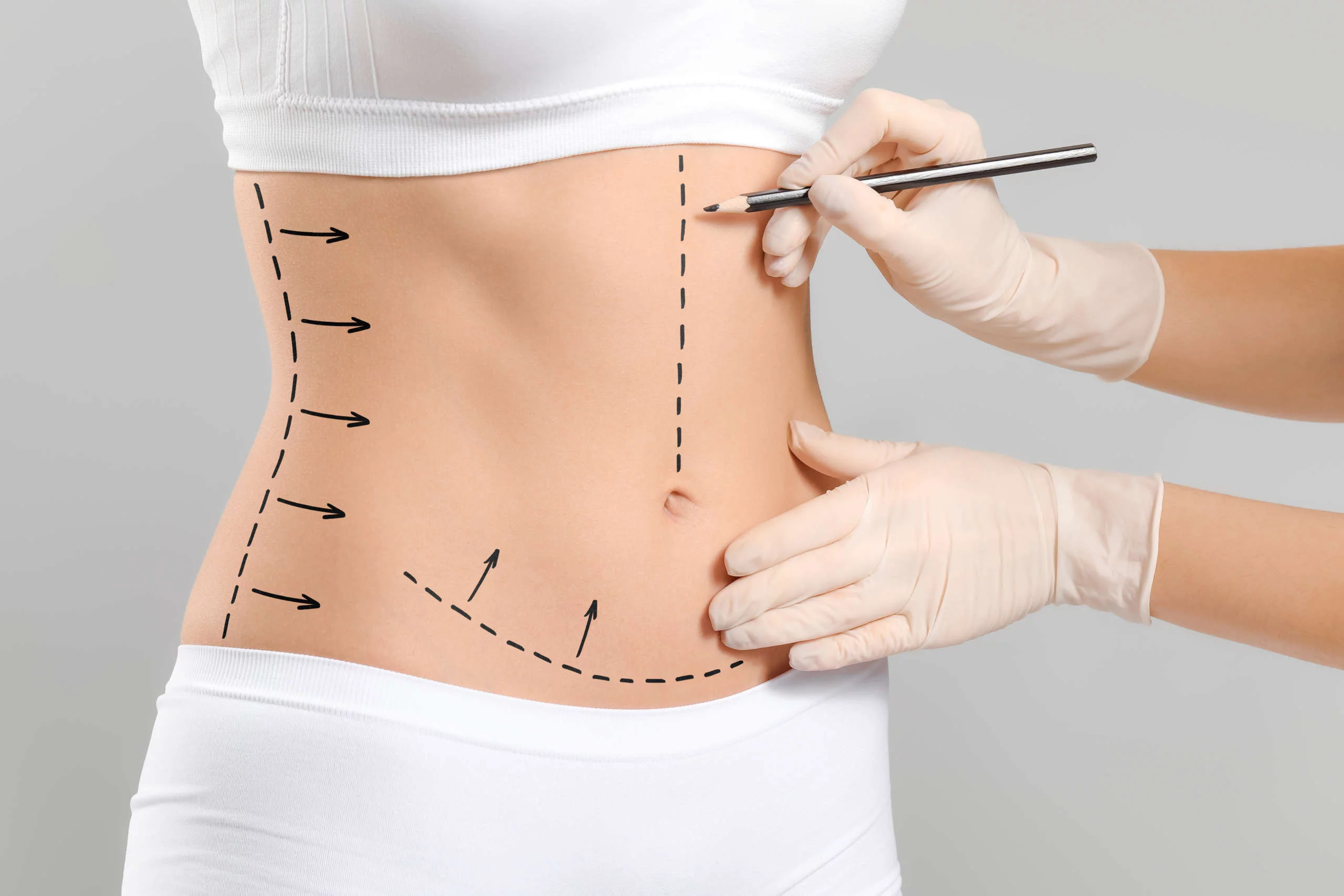 Abdominoplastie