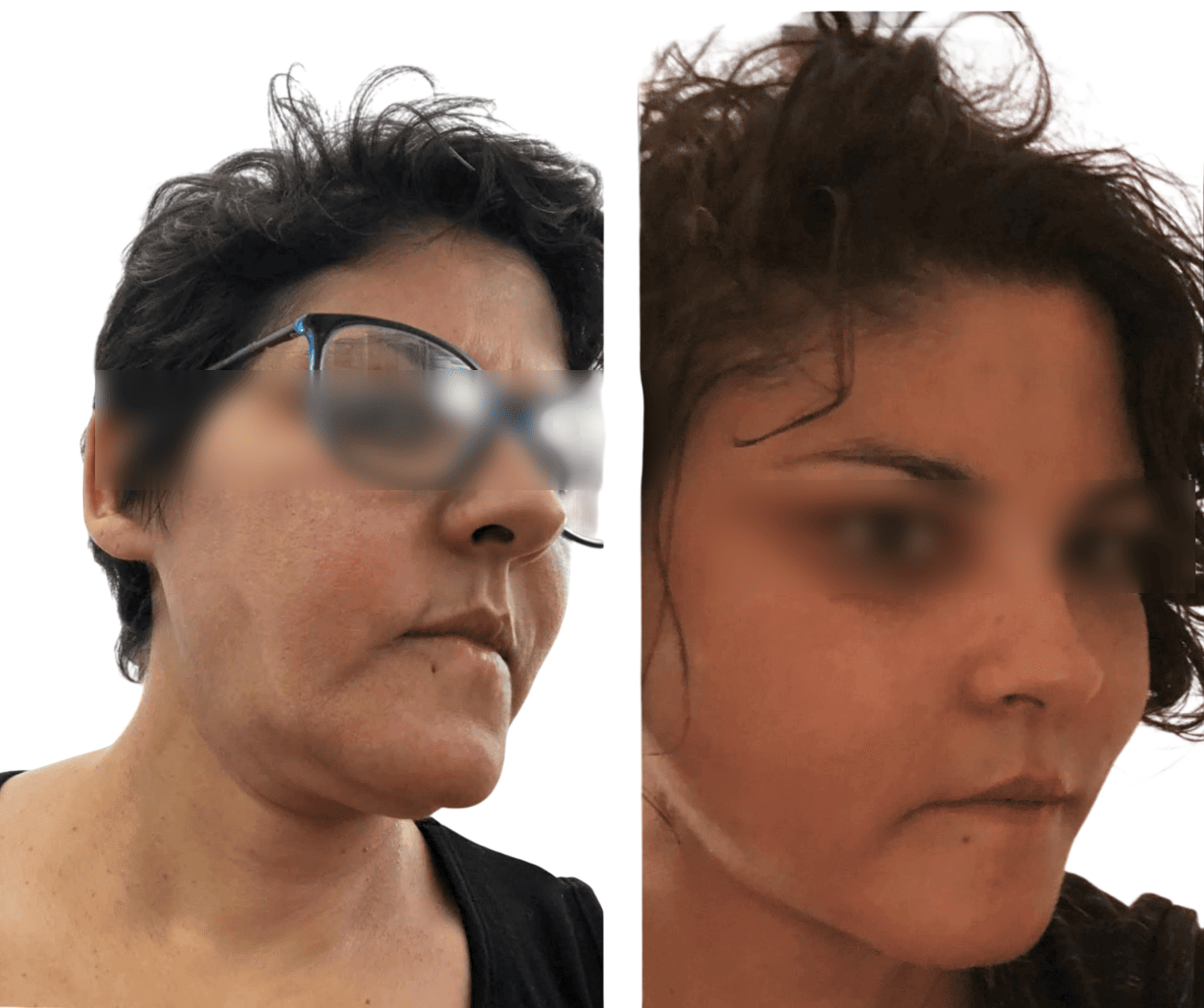 Diagram of the anatomical planes of the face illustrating the deep plane facelift technique and repositioning of the SMAS
