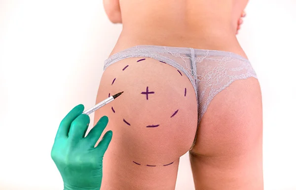 Lifting des fesses