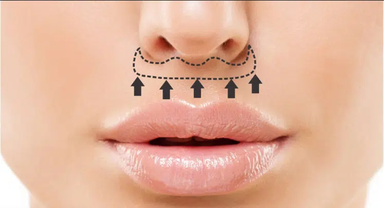 Lip lift